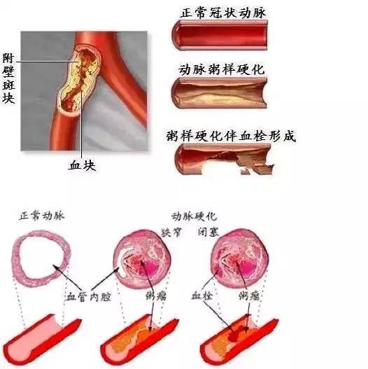 血管是如何一天天堵塞的,看完吓一跳!放到圈子里会感激你一辈子!